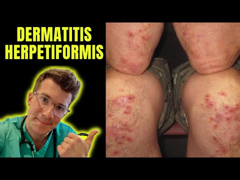 Dermatitis Herpetiformis (rash seen in Coeliac Disease aka gluten intolerance) explained…