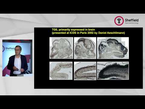 Gluten Sensitivity: a disease of the brain : Professor Marios Hadjivassiliou