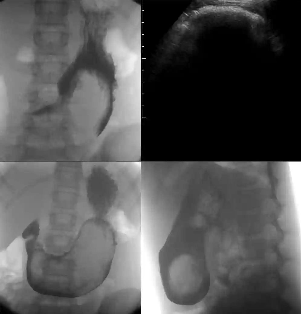 Trichobezoar Reveals Undiagnosed Celiac Disease in Young Woman: A Rare Case Study